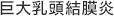 巨大乳頭結膜炎